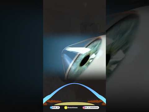 القرنية المخروطية أسبابها وعلاجها