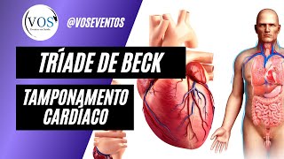 Tríade de Beck | Tamponamento Cardíaco