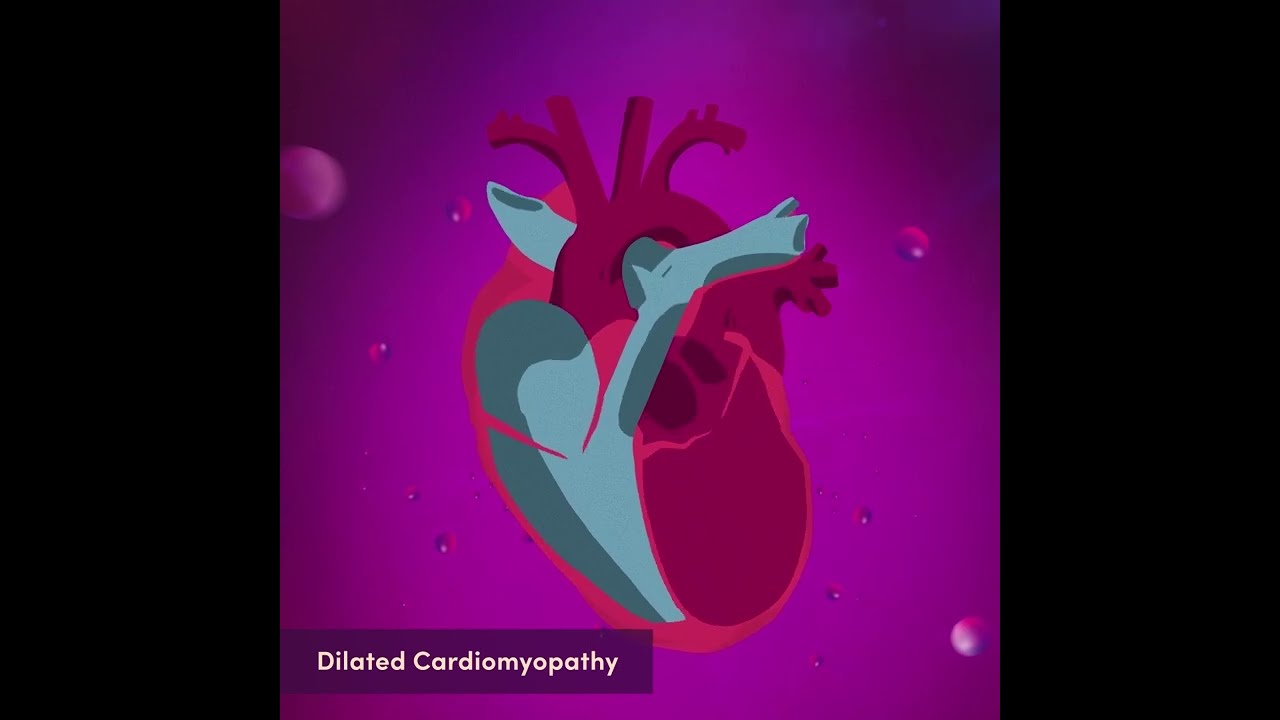 Dilated Cardiomyopathy DCM 