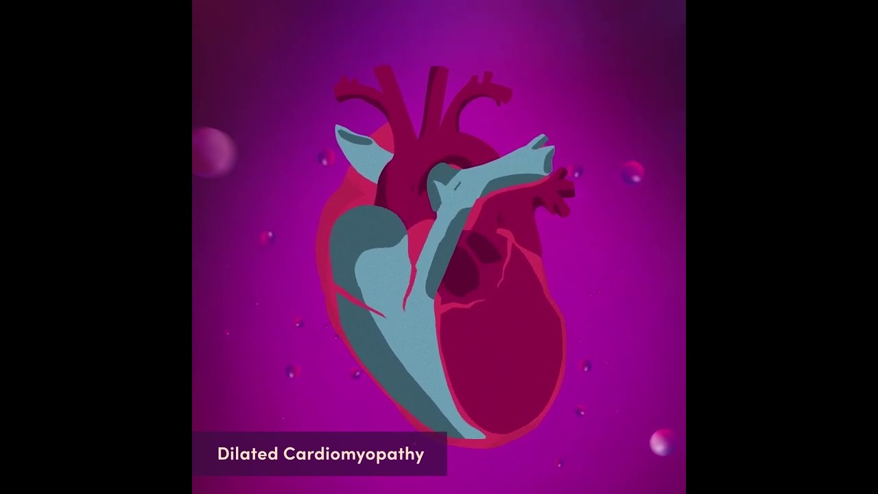 Dilated cardiomyopathy (DCM)