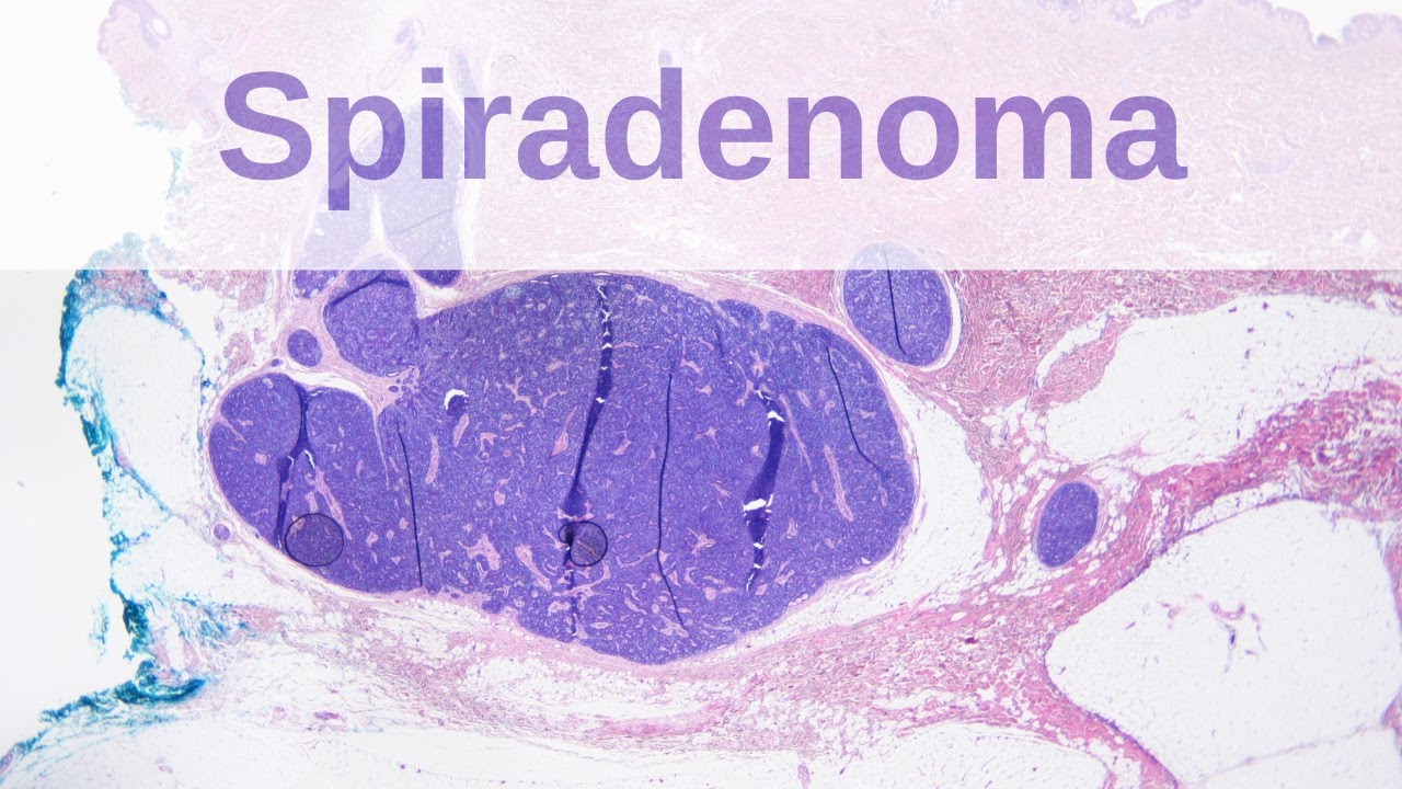 Eccrine Spiradenoma - Pathology mini tutorial