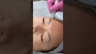 Introducing The Best Microneedling Aka Collagen Induction Therapy