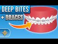 How Do Braces Fix Deep Bites? | Premier Orthodontics