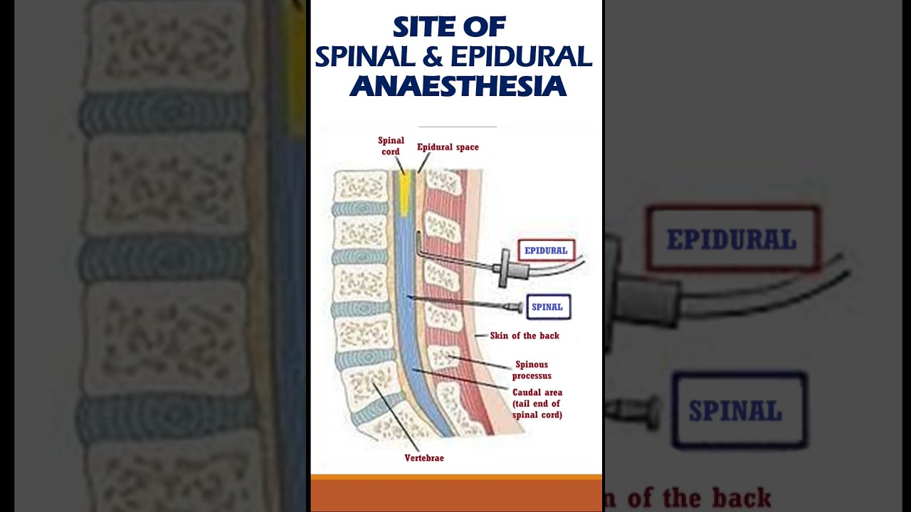 SPINAL v/s EPIDURAL ANAESTHESIA | SITE & METHOD OF ADMINISTRATION | SURGERY 