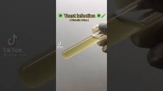 Yeast Infection As Seen Under The Microscope.