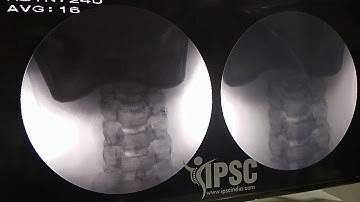 Cervical mediaL branch Radiofrequency ablation technique.