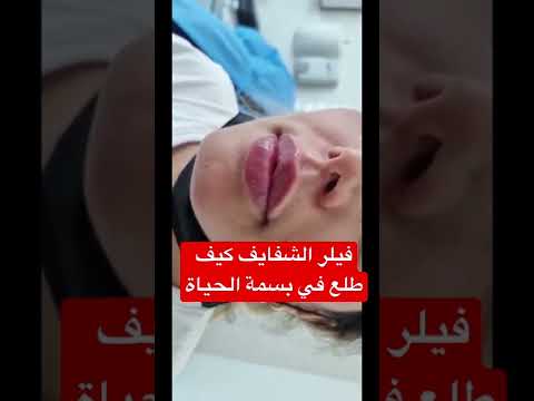 فيلر الشفايف كيف طلع في في بسمة الحياة الطبي