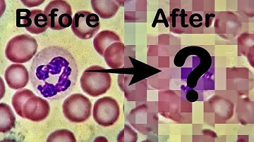 Any Change in Blood Cell Shape Pre and Post Covid Vaccination & Infection??