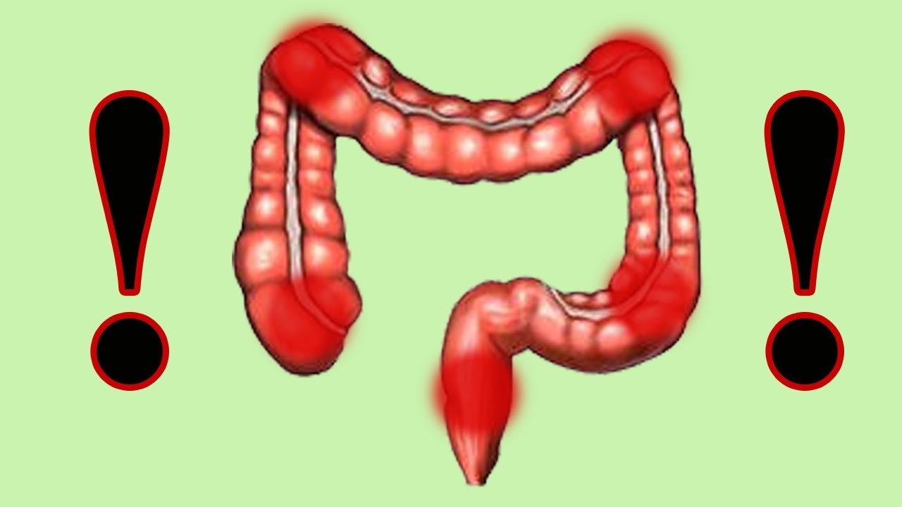 Онкология толстого кишечника. Опухоли, полипы, кисты. 7-летний опыт ...