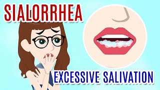 SIALORRHEA (EXCESSIVE SALIVATION): Causes, Diagnosis and Treatments