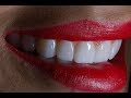 Procedure of applying porcelain dental veneers at cosmetic dental associates