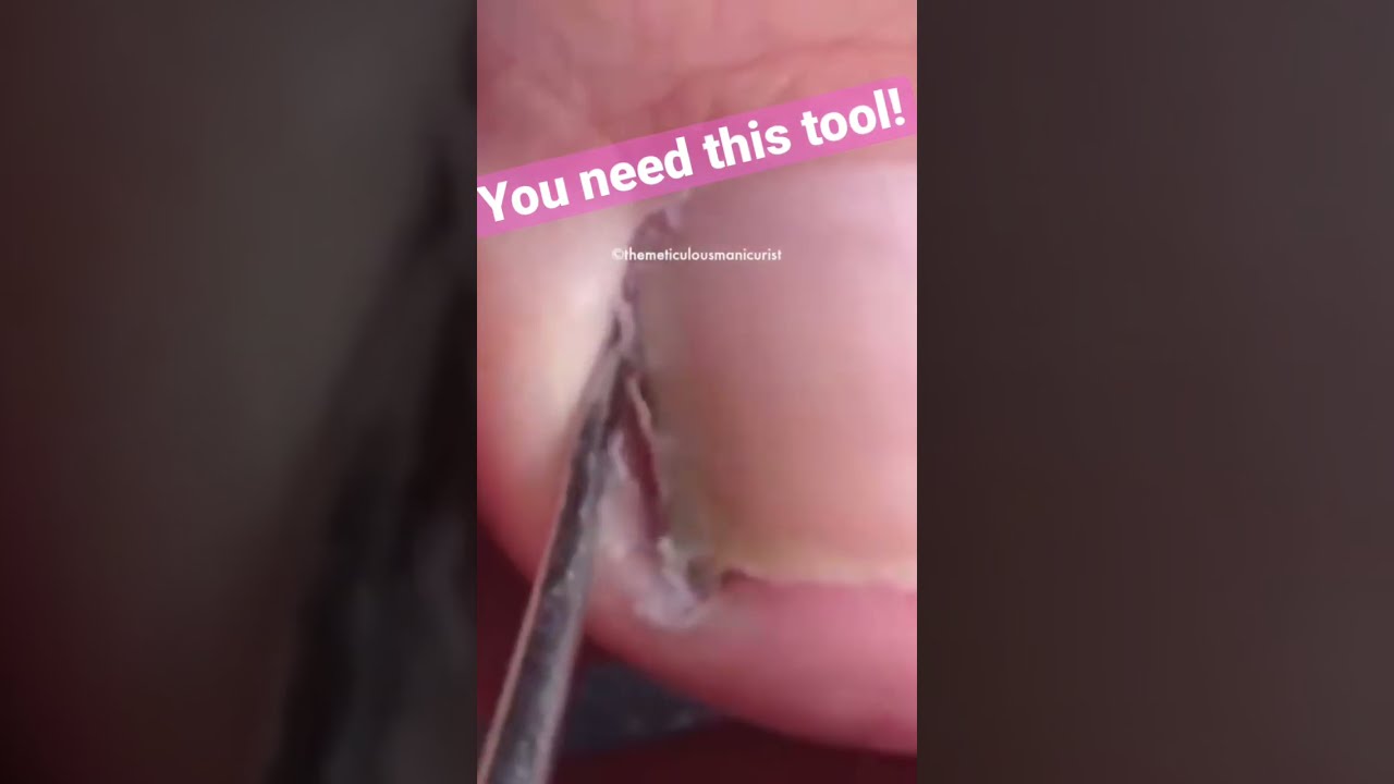 Cleaning With Toenail Rasp Pedicure Naileducation