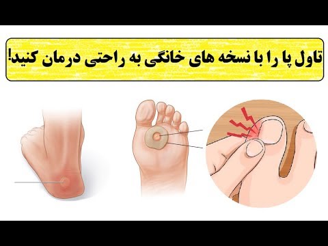 تصویری: 4 راه درمان تاول پا