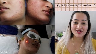 Laser Genesis Before and After Results for Acne Scars ♡ GIVEAWAY included