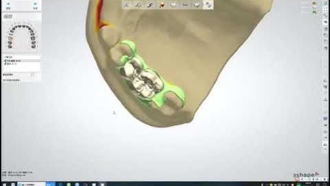 Cad/cam resin bonded fixed partial denture