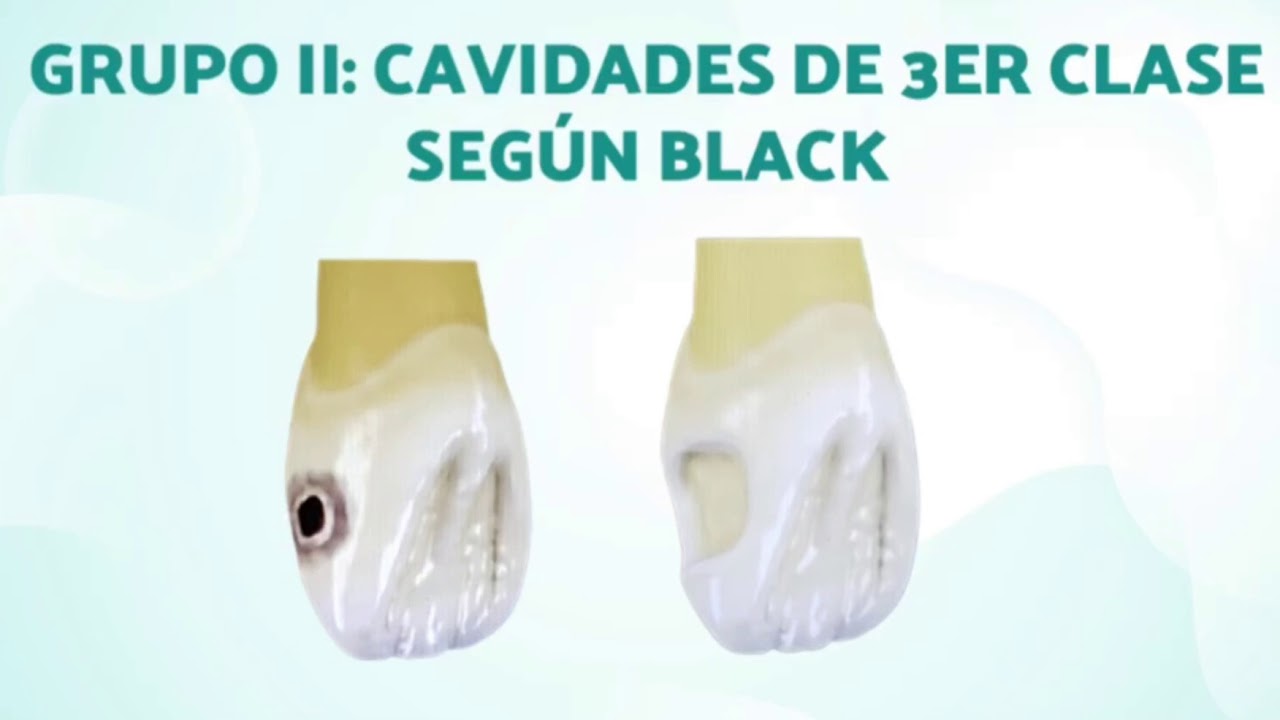 Clasificación de las Cavidades Según Black / Operatoria Dental I - YouTube
