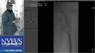 Live Case Presentation #2  ISR Schmidt Session II   Superficial femoral artery PART II