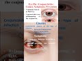 Eye flu आँखों का फ्लू  se "कैसे बचे" , eye flu hone pe kya kre causes, symptoms and prevention.