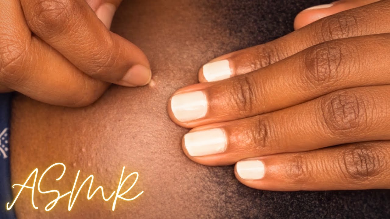 EXTREME Scalp Edge Nitpicking ASMR 😮‍💨✨ | So Detailed It’ll Give You Instant Tingles