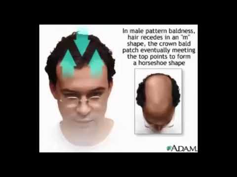 Hair Thinning At Crown Female Treatment Hair Regrowth Youtube