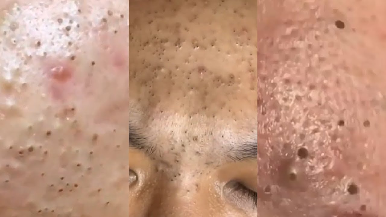 Blackheads on Forehead ! Relax Acne Treatment Every Day YouTube