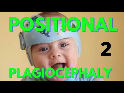 What is Positional or Deformational Plagiocephaly/Symptoms/Diagnosis/Treatment 2nd part