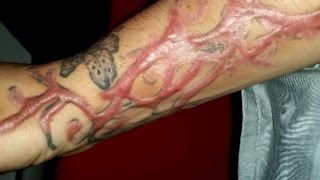 Tattoo-removal procedures leave clients scarred for life screenshot 4