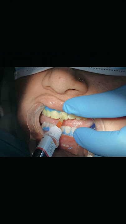 Download lagu Power whitening | white smile | teeth whitening (German technology) by Dr_Mirza_Muneeb