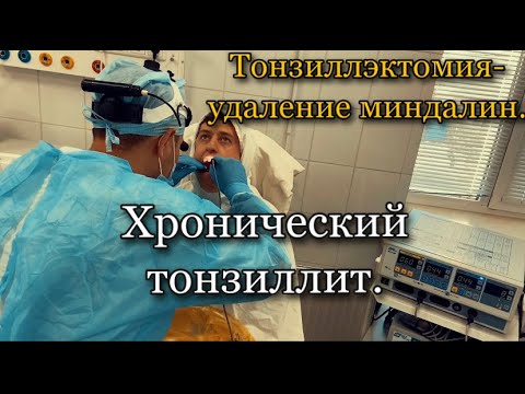 ХРОНИЧЕСКИЙ ТОНЗИЛЛИТ. Тонзиллэктомия - удаление небных миндалин.