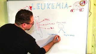 سرطانات الدم leukemia AML ALL CLL CML blast cells