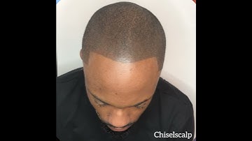 Chisel Scalp SMP Procedure 14 (Hair Restoration solution)