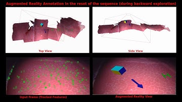 Live Tracking and Dense Reconstruction for Hand held Monocular Endoscopy-VIDEO