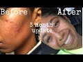 Urban Skin RX Clear Skin Bar 3 Month Review | Pictures Included | Ri's Remedies