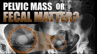 Pelvic Mass or Fecal Matter? #xray #radiology