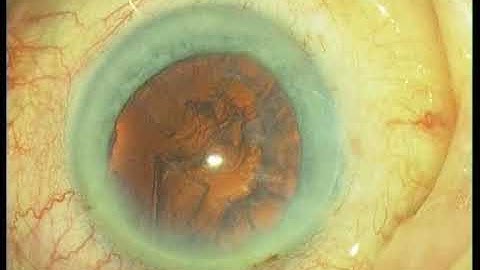 Part II: Easy cataract; divide and conquer