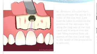 Endodontic Microsurgery