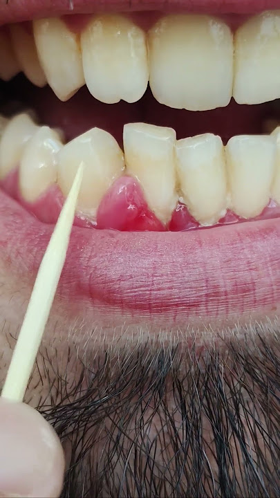 Teeth not cleaning because of that big gum #gums #dentalcare #satisfyingvideos