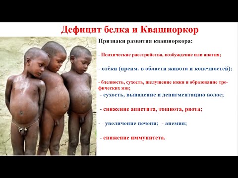 Видео: Ранняя диагностика дефицита липазы в лизосомальной кислоте у детей с появлением доступной фермент-заместительной терапии