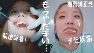 【歯列矯正#5】半年経過！前歯装着＆下の抜歯/痛み、見た目の変化【表側ワイヤー矯正】