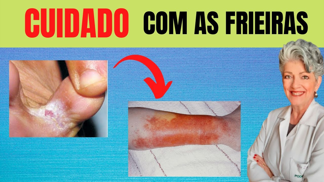 Cuidado com as Frieiras nos Pés - YouTube