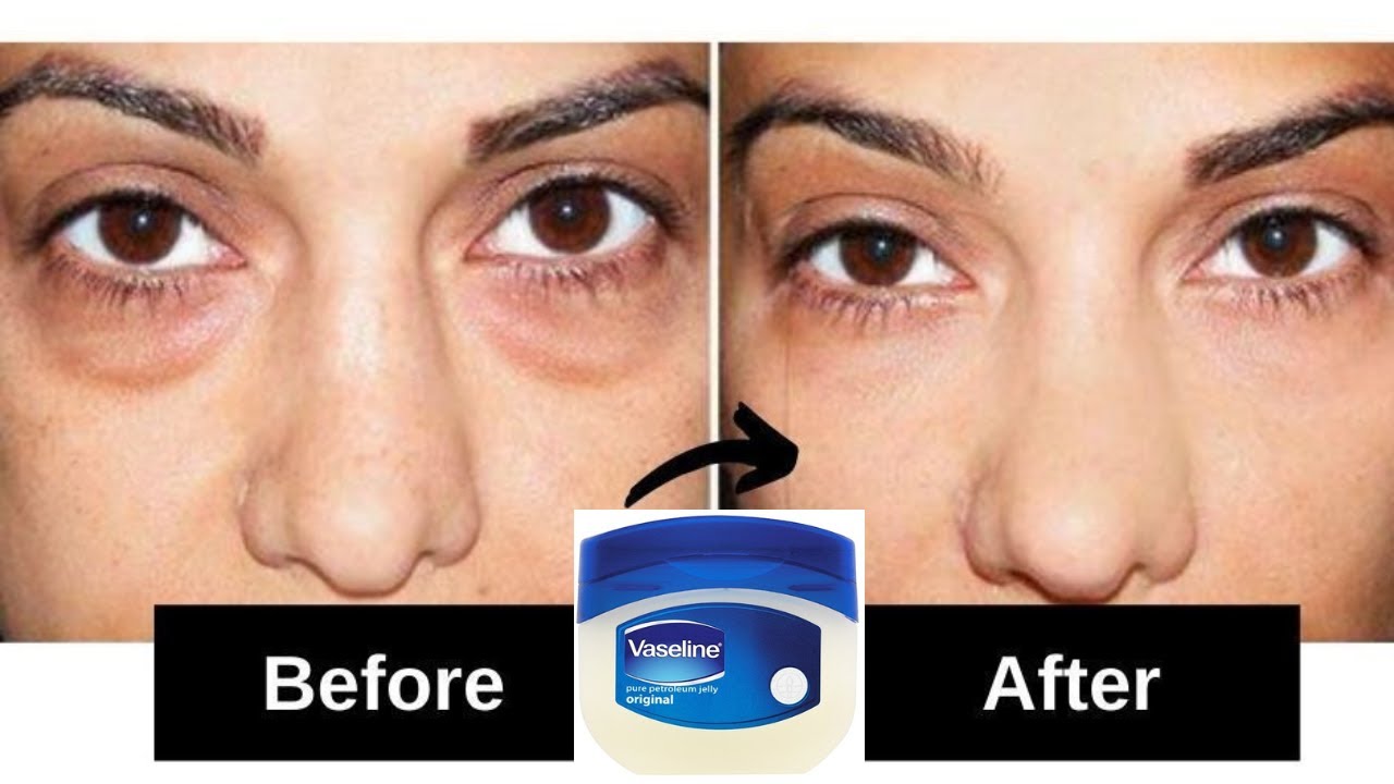 In 3Days Remove Under Eye Bags Completely 🔥Remove Dark Circle, Wrinkels