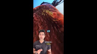 How Maggots Heal Wounds