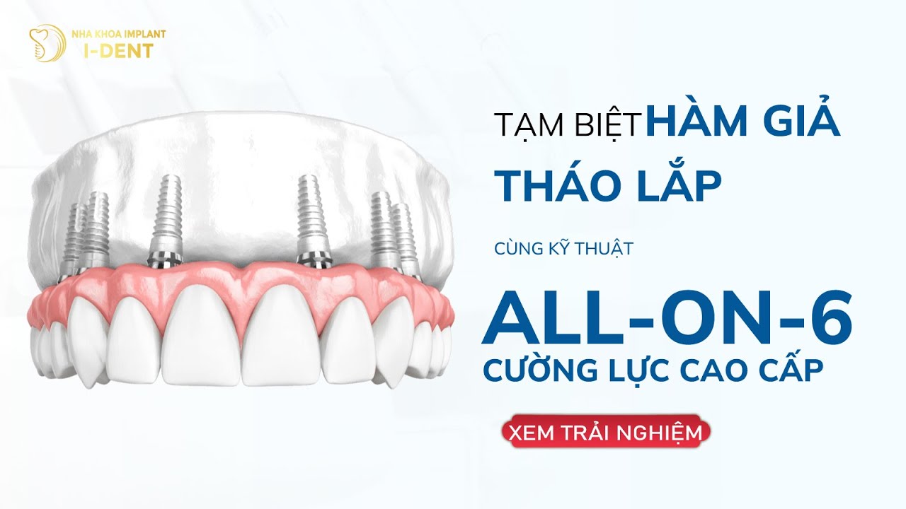 Tạm Biệt Hàm Giả – Trồng Răng All-on-6 Sau 3 Ngày Có Răng