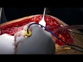 Left Internal Mammary  Artery Take Down