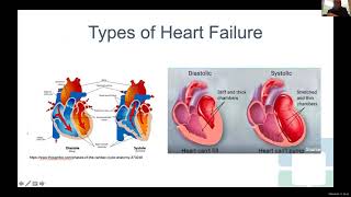 ATTR Cardiac Amyloidosis