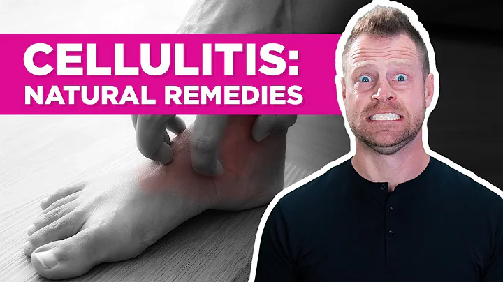 Stop Recurring Cellulitis: 4 Proven Home Remedies for Natural Healing