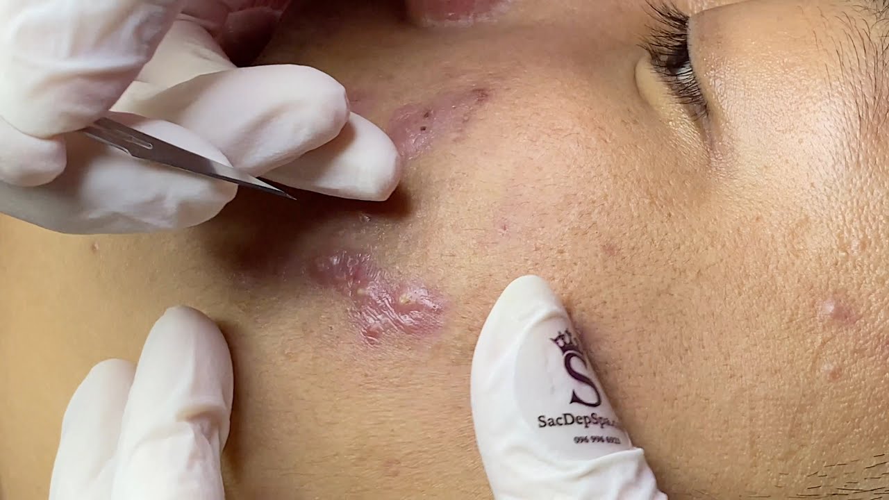 Inflamed Acne (Cystic Acne and Other Types) | Điều Trị Mụn Viêm - SacDepspa#247