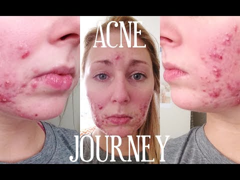 MY CYSTIC ACNE STORY | ACCUTANE & PICTURES
