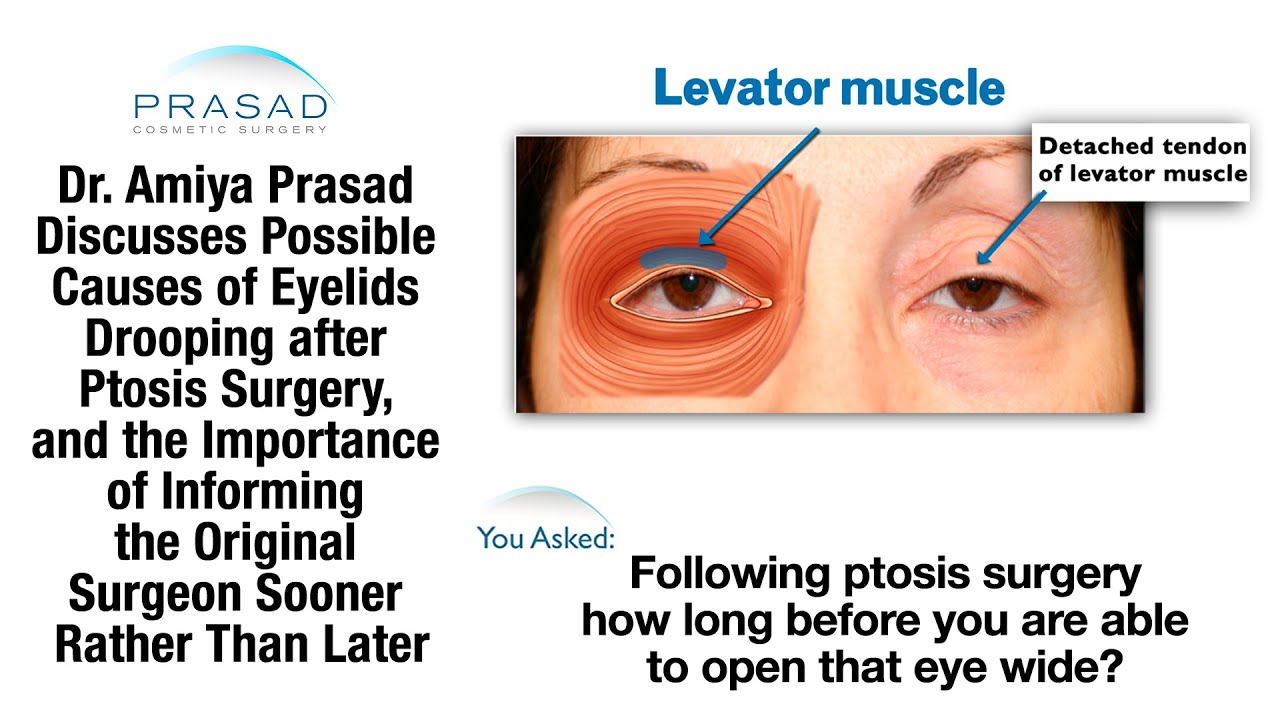What to Expect after Congenital Ptosis Surgery and its Possible