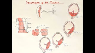 Placental Abnormalities - accreta, previa, abruption, multi lobar